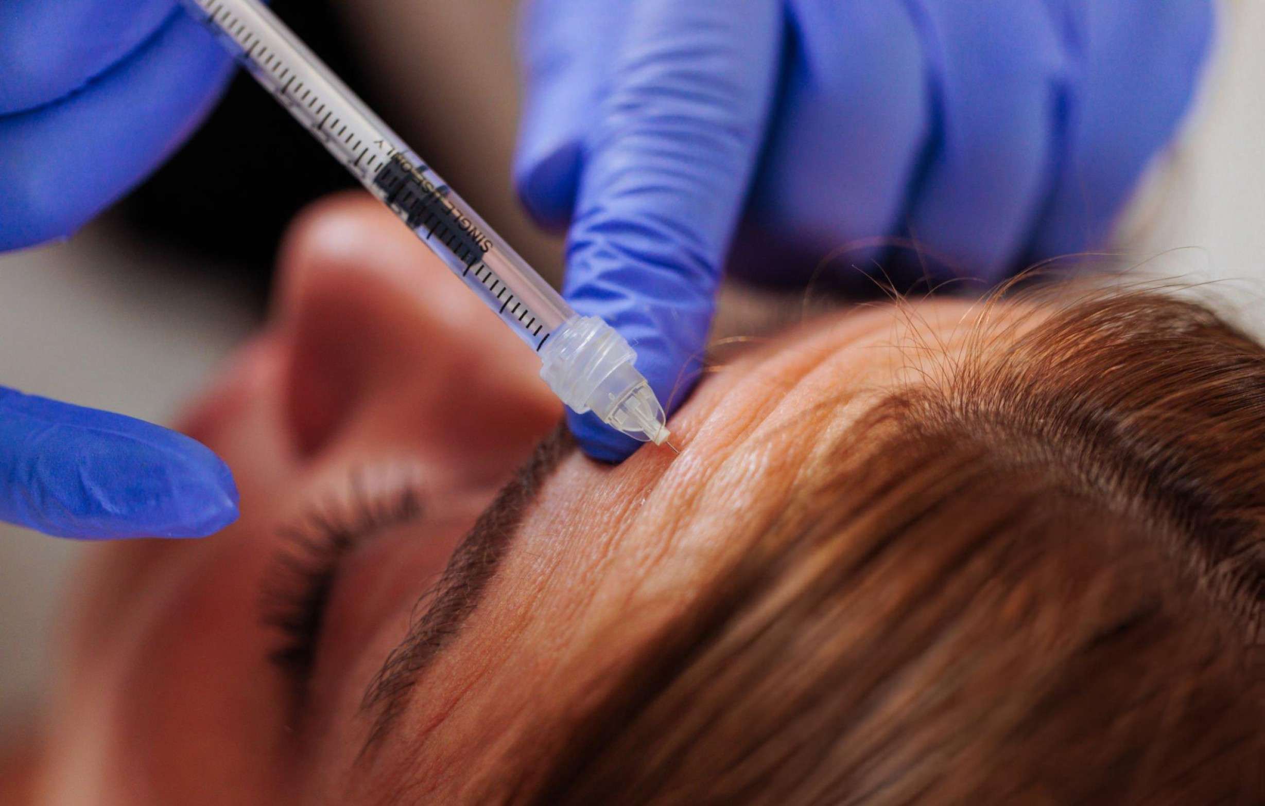 Dermal filler results